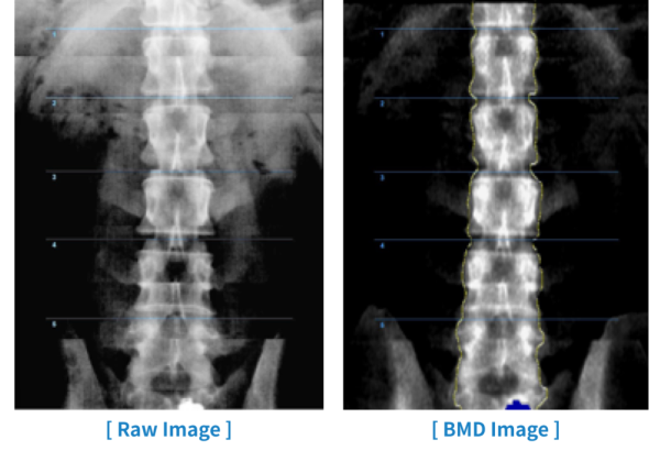 Bone Densitometer Medikors InAlyzer Air – Bild 5